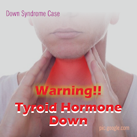 Lekurangan Hormon Tiroid
