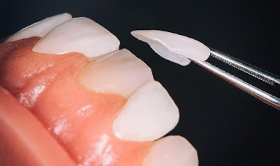  Quy trình dán răng sứ bao nhiêu tiền? 