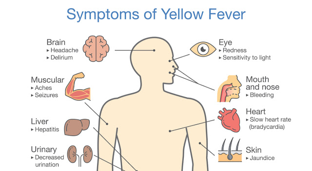 Picture of Symptoms of Yellow Fever