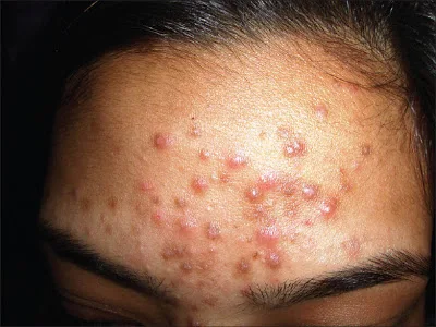 Acne And Pimple And Treatments