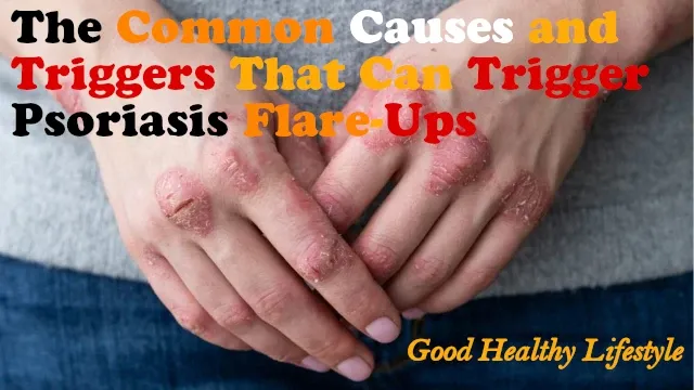 The Common Triggers that Can Flare Up Your Psoriasis