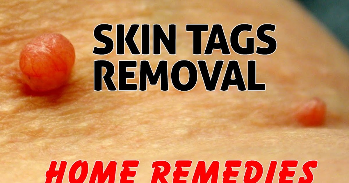 Home Remedies for Skin Tag Removal