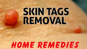 Home Remedies for Skin Tag Removal