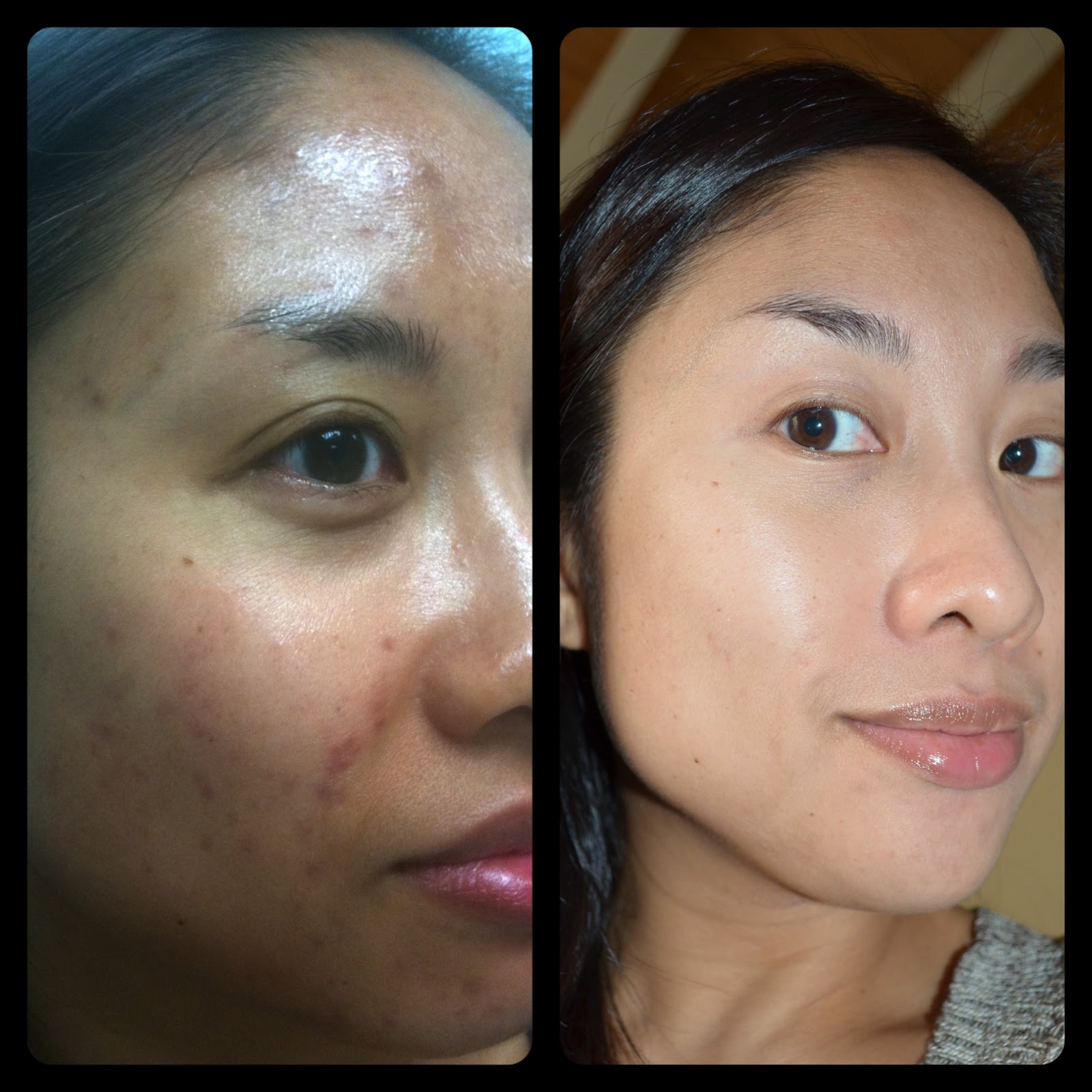 Obagi NuDerm for Acne and Hyperpigmentation â€