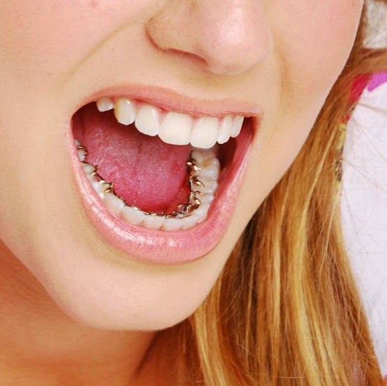 Tìm hiểu Phương pháp niềng răng là gì?