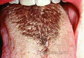 causes of black hairy tongue
