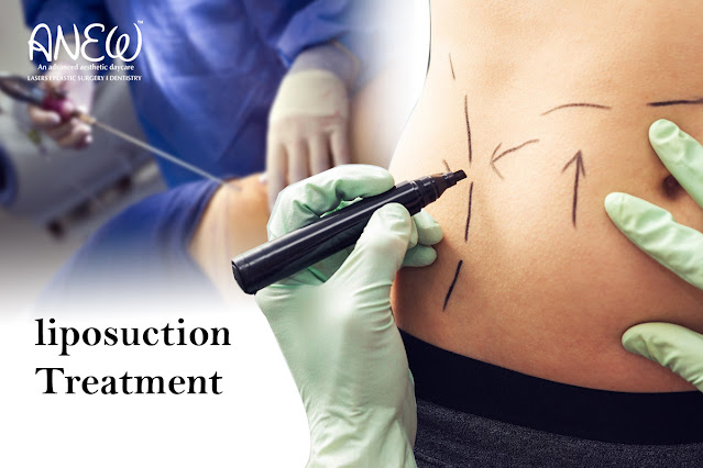 Liposuction In Bangalore