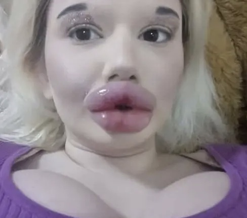 Lady With The ‘Biggest Lips In The World’ Reveals Plans To Make It More Bigger