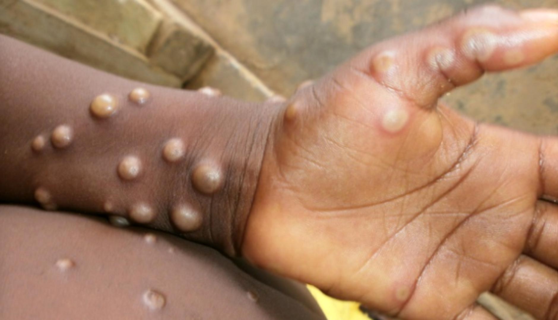 What Are the Symptoms of the Monkeypox?