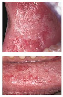 Morsicatio Buccarum/Labiorum (Cheek and Lip Chewing)