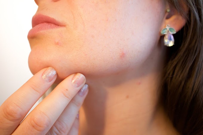 The treatment of Acne using natural remedies.