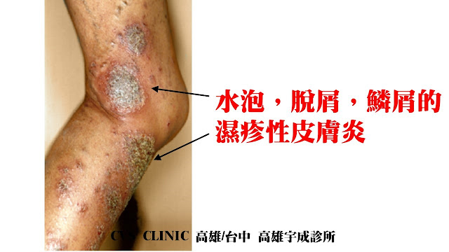 靜脈曲張伴隨濕疹, varicose veins with eczema