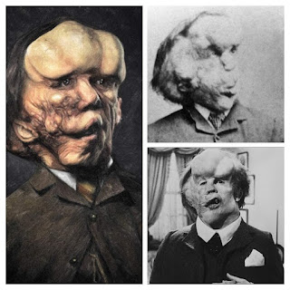 Joseph Merrick