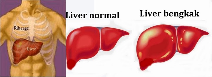 Obat Penyakit Liver Bengkak 