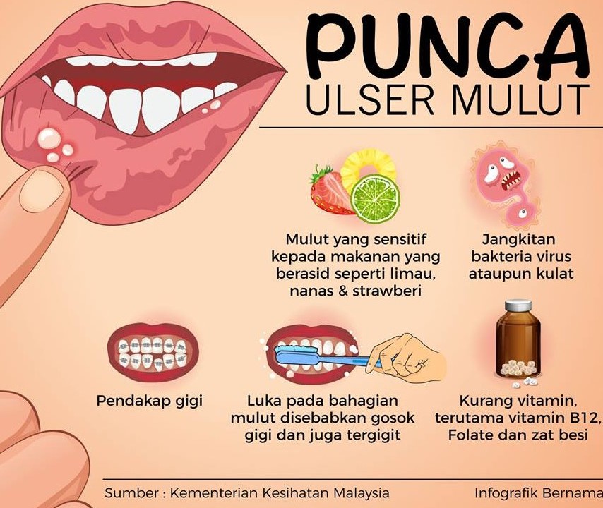 Cara Mudah Atasi Ulser Mulut Bagi Kanak Kanak