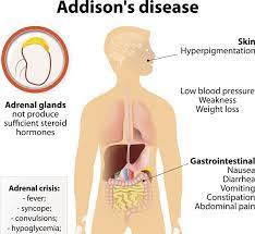 Understanding Addison's Disease