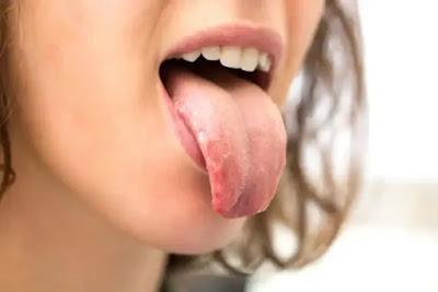 Pourquoi la bouche se dessèche-t-elle chez les personnes atteintes de diabète ?