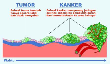 Perbedaan tumor dan kanker