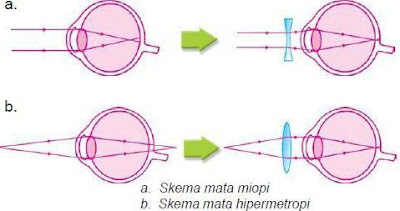 Kelainan dan Penyakit pada Sistem Alat Indra Mata Manusia beserta Gambarnya