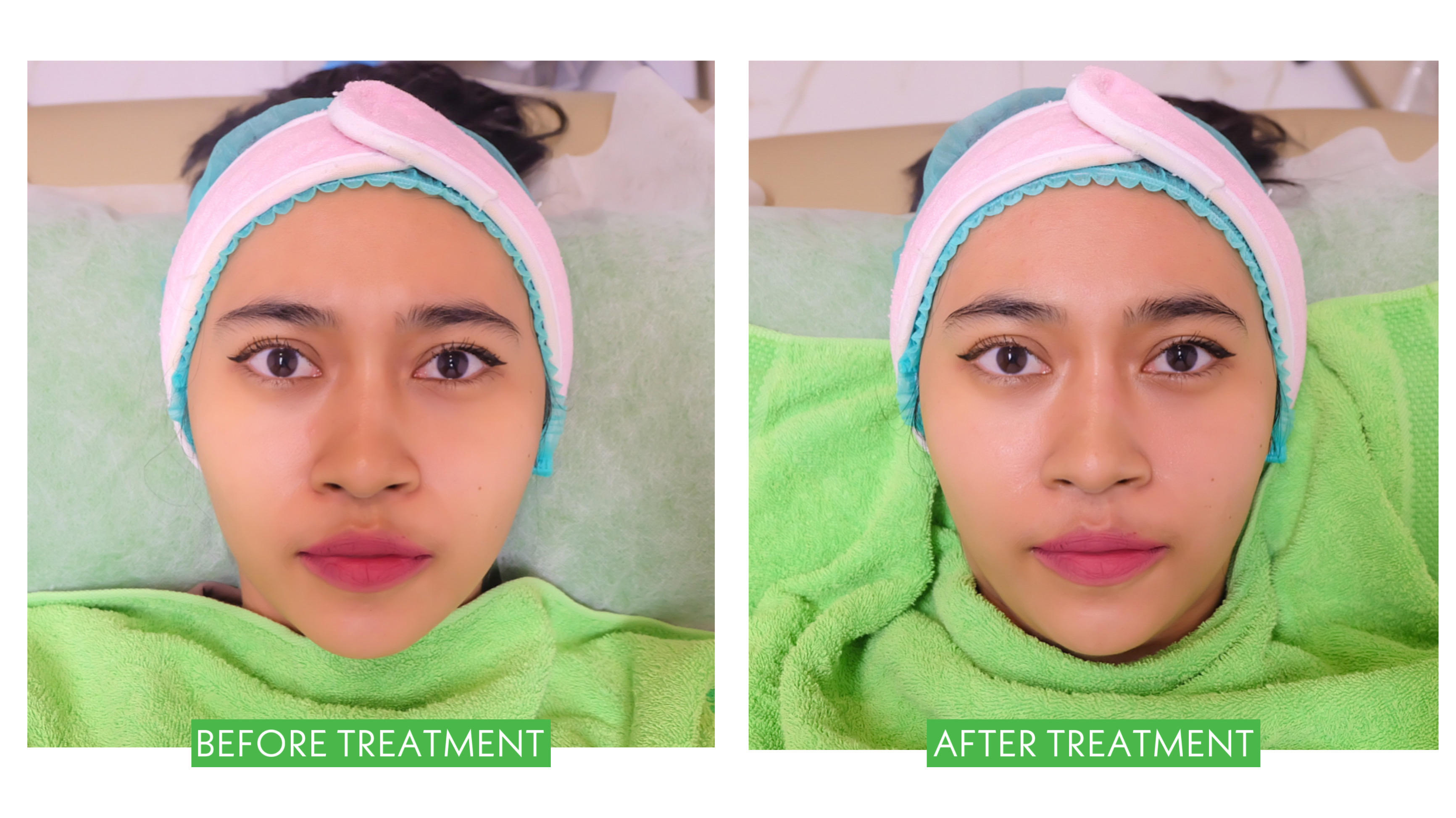 [Review] Treatment DNA Salmon Micro Injection di ZAP Clinic