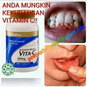 penyakit skurvi akibat kekurangan vitamin c