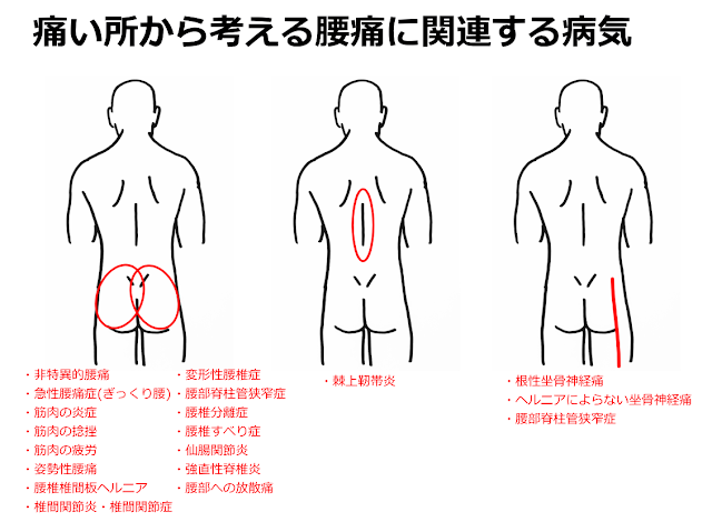 痛いところから考える腰痛に関連する病気