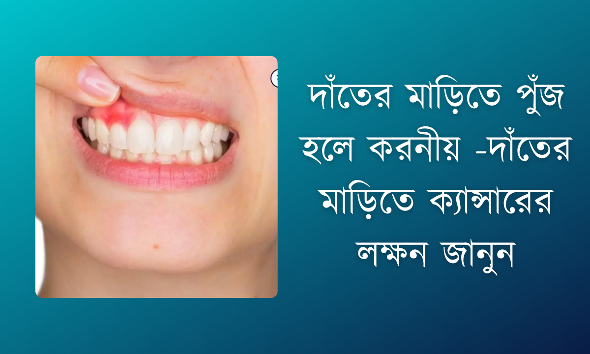 দাঁতের মাড়িতে পুঁজ হলে করনীয় | দাঁতের মাড়িতে ক্যান্সারের লক্ষন জানুন