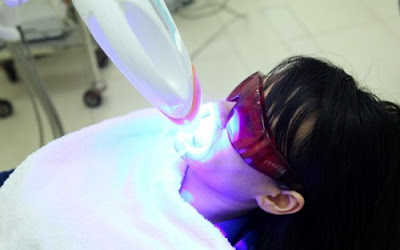 Trám răng bằng công nghệ Laser Tech