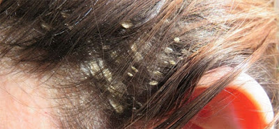  Bệnh nấm da đầu là gì?