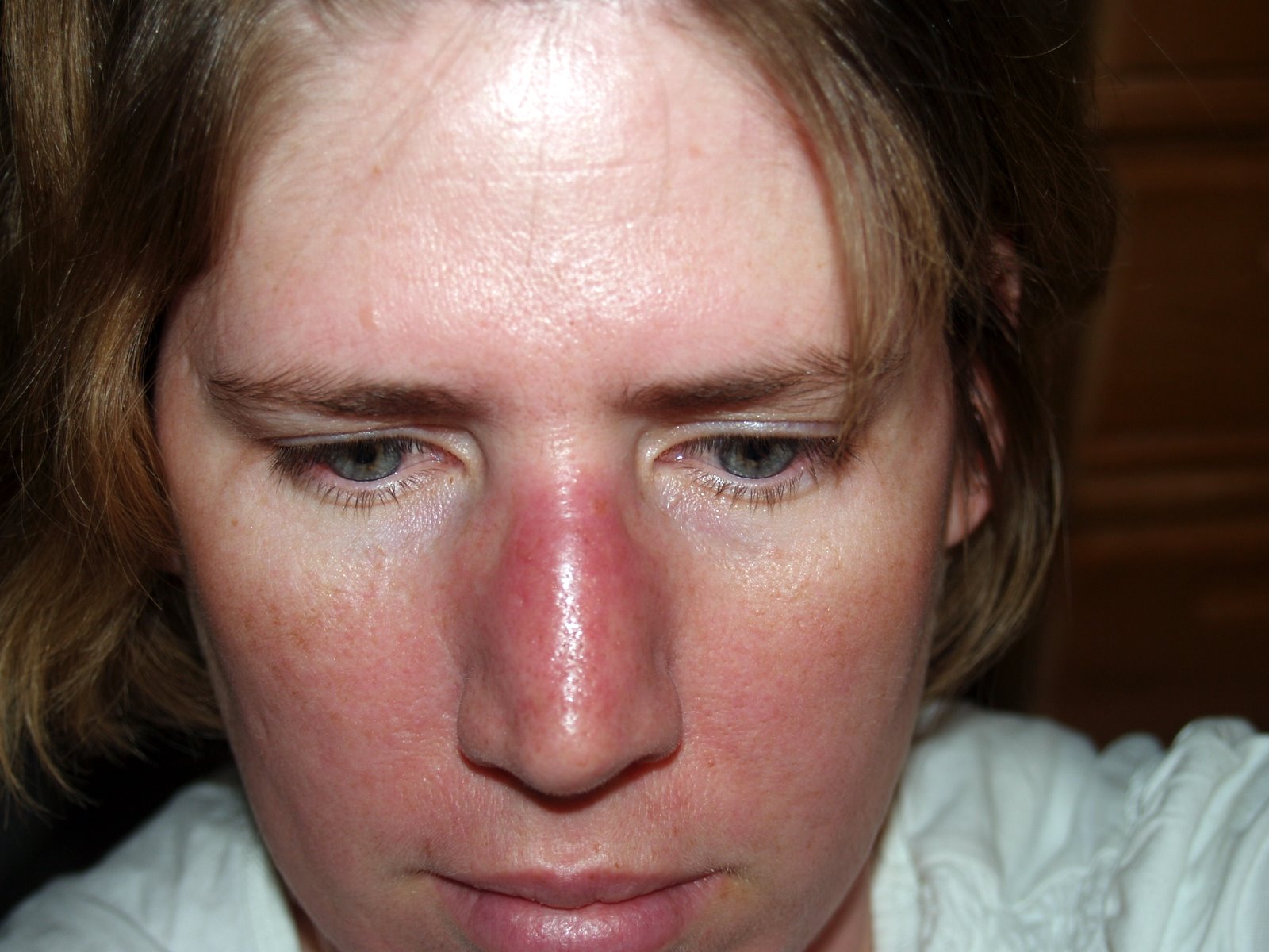 Cellulitis In Nose