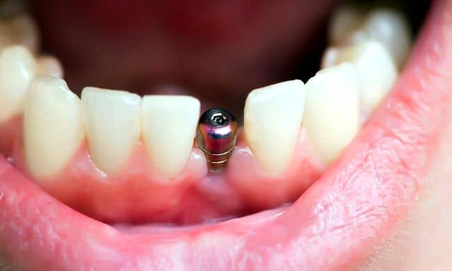 Implantes Dentales