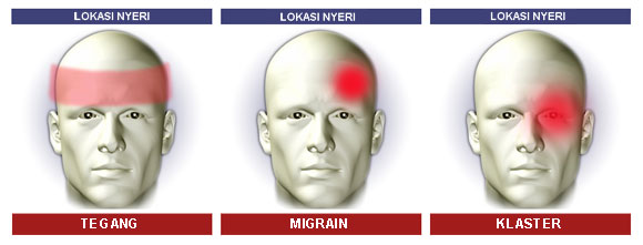 Jenis, Penyebab, dan Pengobatan Sakit Kepala | Medkes