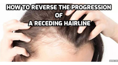 A receding hairline is a common concern among men and can significantly impact their appearance and self-confidence. Fortunately, there are various treatment options available to reverse the progression of a receding hairline and restore a fuller and more youthful hairline.