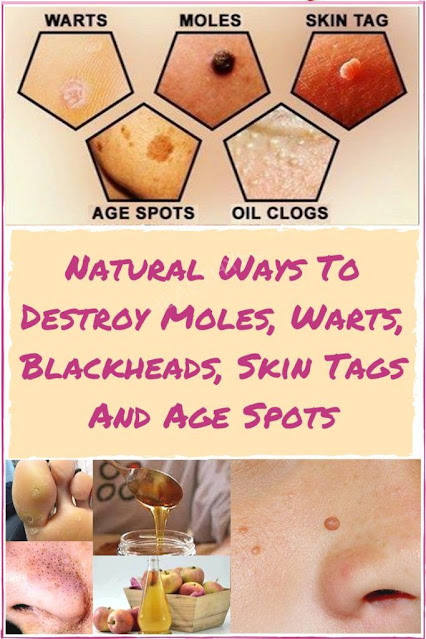 Destroy Your Moles, Warts, Blackheads, Skin Tags And Age Spots Completely Naturally