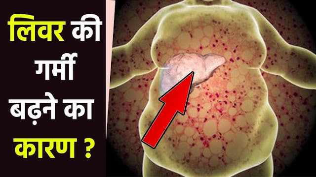 लीवर हीट के लक्षण और कारण: पूरी जानकारी