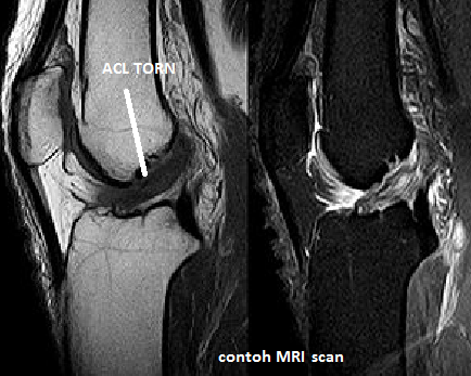 Rai azman @ knee pain - anterior cruciate ligament (ACL)