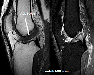 Rai azman @ knee pain - anterior cruciate ligament (ACL)