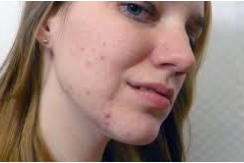 How to reduce acne scars quickly and naturally with ease