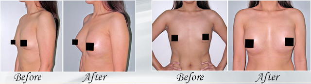 Know Everything About Breast Augmentation