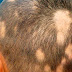 Caída de pelo o alopecia
