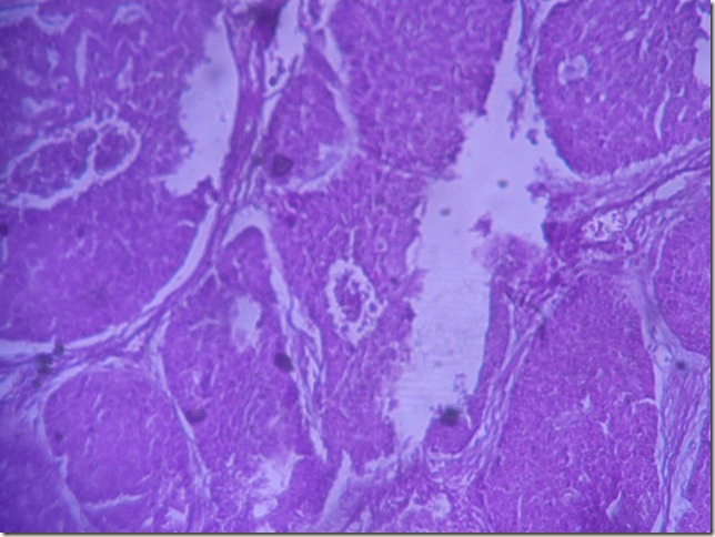 basal cell CA histopathology