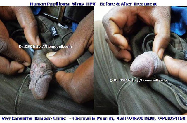  wart in penis, wart in vagina, wart in anus, KUNJIYIL MARU,aanurupil maru, pundaiyil maru,