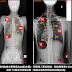 脊椎側彎矯正案例21 - 多(4)曲線側彎/ 22度~14度