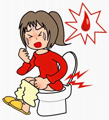 Penyebab Gejala Penyakit Wasir Dan Cara Mengobati Wasir Luar Dalam
