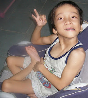 Cerebral Palsy