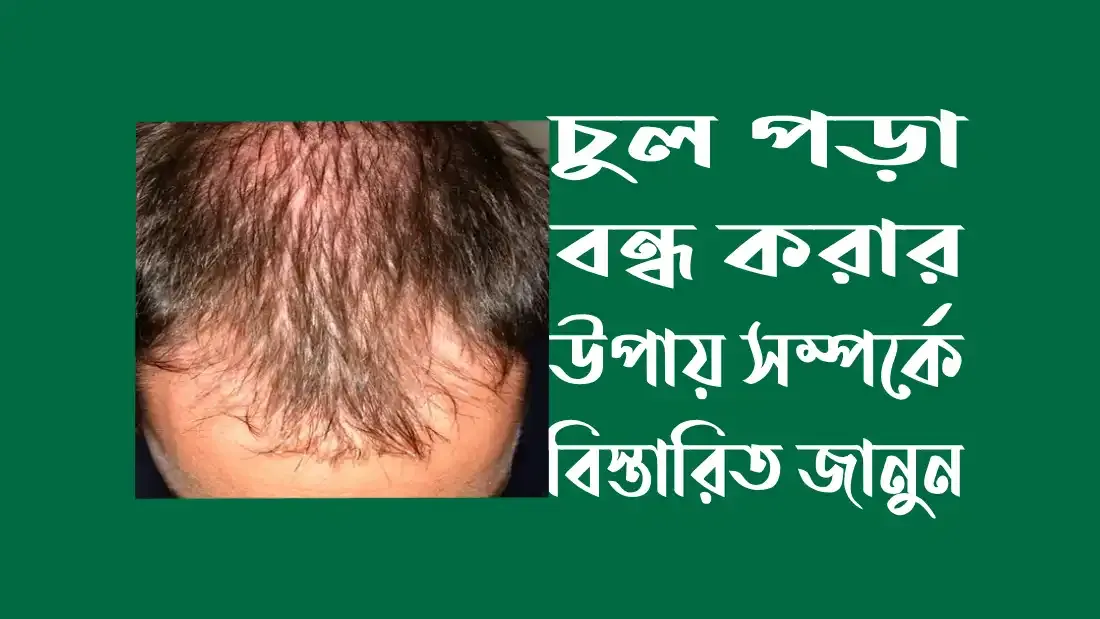 চুল-পড়া-বন্ধ-করার-উপায়-সম্পর্কে-জানুন