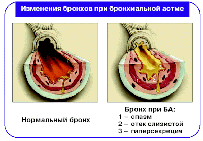 болезнь астма, как лечить астму, вылечить астму, нородное лечение астмы, народные методы лечения бронхиальной астмы