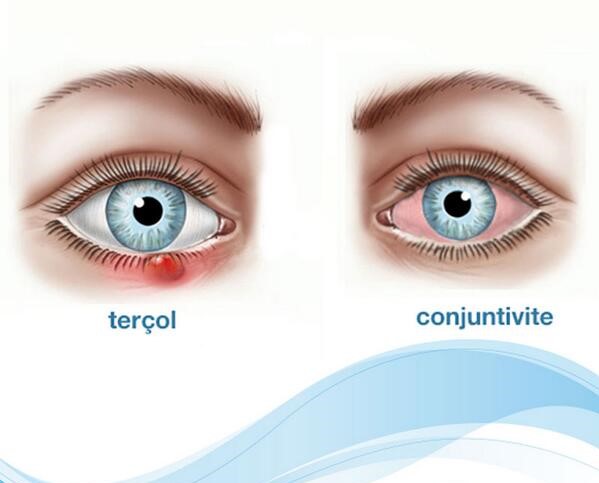 http://www.estou-crescendo.com/2018/04/conjuntivite-e-tercol-saiba-qual-e.html