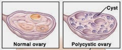 Ovário-Policístico-cópia