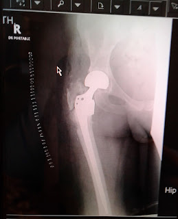 An xray of my new hip. You can see the bipolar implant. 